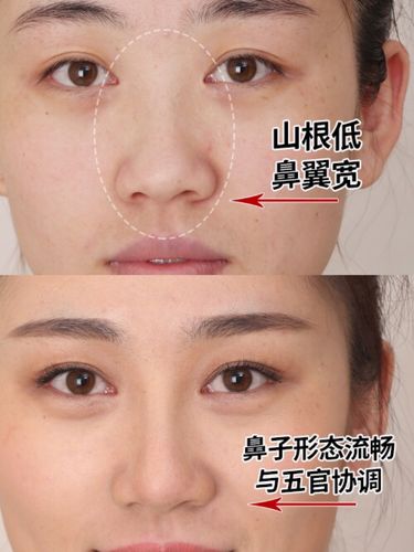 区别图片鼻梁低山根低鼻头大山根低的女人山根和鼻梁的区别图鼻子山根
