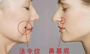 八字鼻怎么办为什么鼻子旁边有八字纹，(鼻子两侧八字纹怎